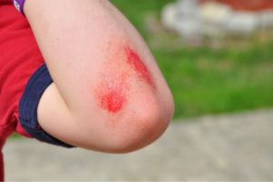 scraped elbow